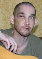 Jimmy Lee Dean, after the brutal July 2008 hate crime attack that nearly took his life.