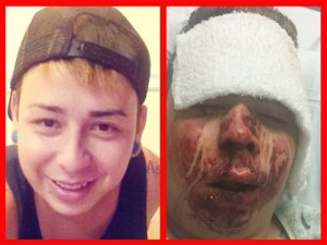 Jared Olson, victim of anti-gay hate crime, before and after the Labor Day Weekend assault.