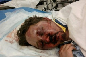 Gay bashing victim Arron Keahey, 24, after teen assailant savagely beat him last Labor Day. 