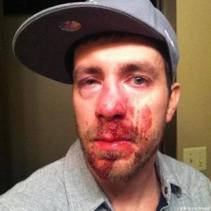 Drew Bartscher, 27, straight ally who spoke out against anti-gay hate speech, and was beaten because of it.