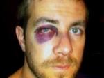 Bartscher's black eye: "I would do it again," he says.